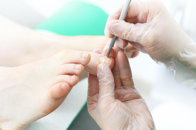 Klamry korygujące wrastające paznokcie