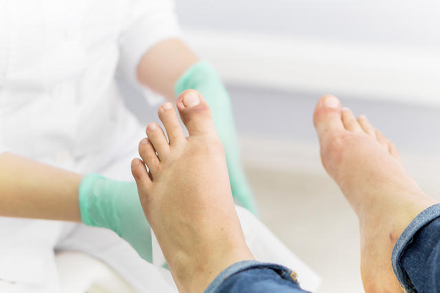 Usuwanie kurzajek i brodawek